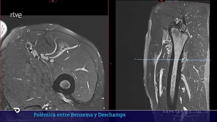 Telediario 1 - El agente de Benzema asegura que podía haber jugado los octavos del Mundial