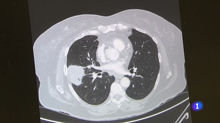 L'Informatiu - La medicina de precisió acorrala el càncer