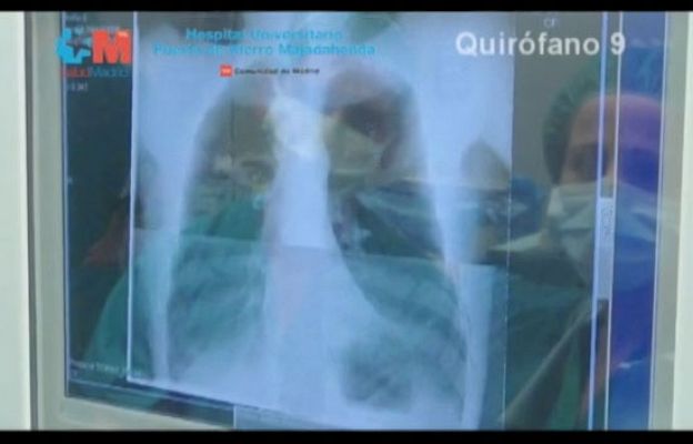 Ciencia y tecnología en Rtve.es - Avance en trasplantes de pulmón