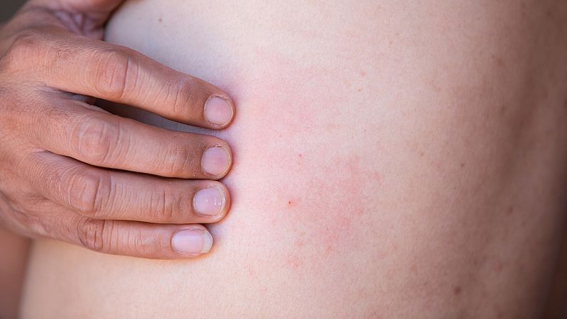 Herpes Zóster, qué es y síntomas de una enfermedad que cada vez afecta a más personas