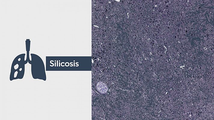 Investigan retraso en el diagnóstico de silocosis