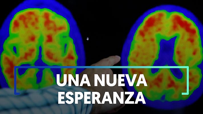 Alzhéimer: Un fármaco experimental ralentiza el deterioro cognitivo un 35% en las primeras etapas