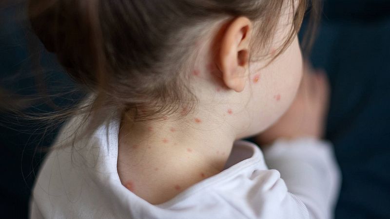 La OMS alerta de un aumento de sarampión en Europa: los casos este año ya multiplican por 30 los de 2022