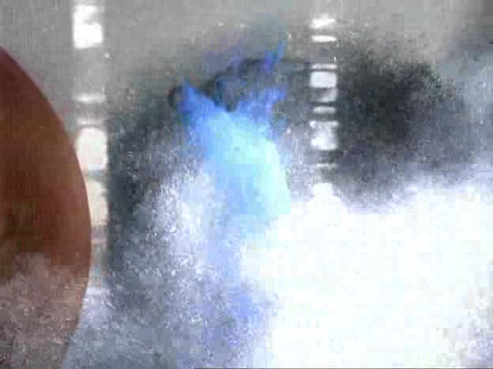 tres14 - Trasplantes y prótesis - tres14 | Ver