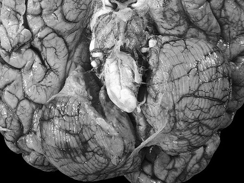  Día Mundial del Parkinson