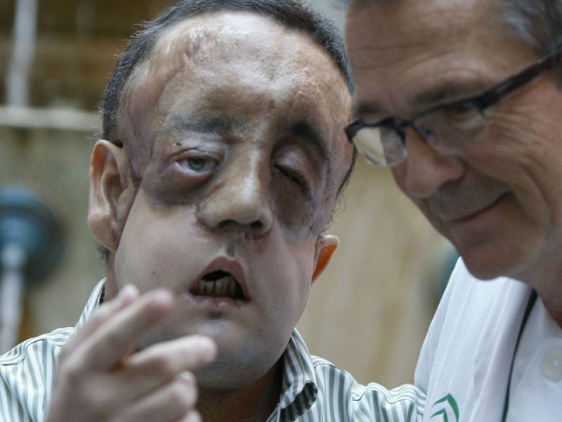 Un trasplantado de cara en España enseña su rostro por primera vez