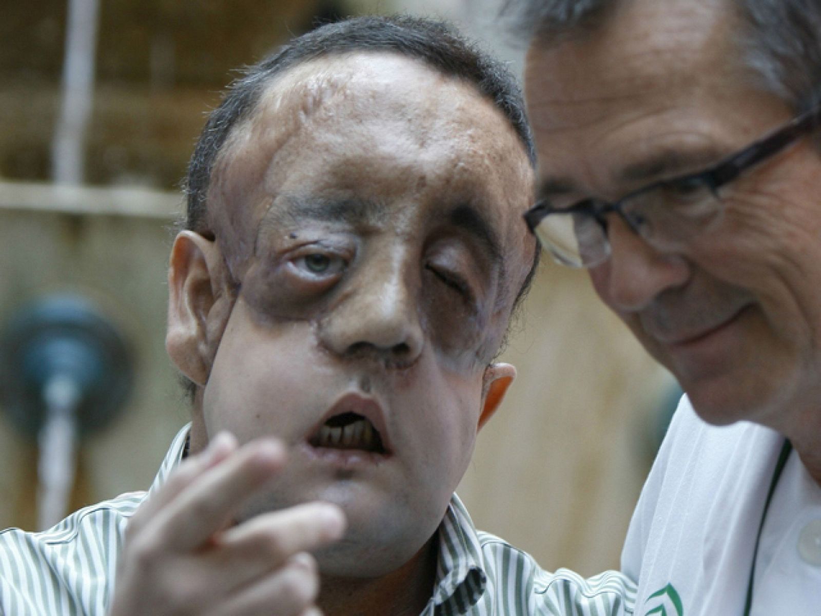 Hoy han dado el alta en el Hospital Virgen del Rocío de Sevilla, al segundo paciente trasplantado de cara en España