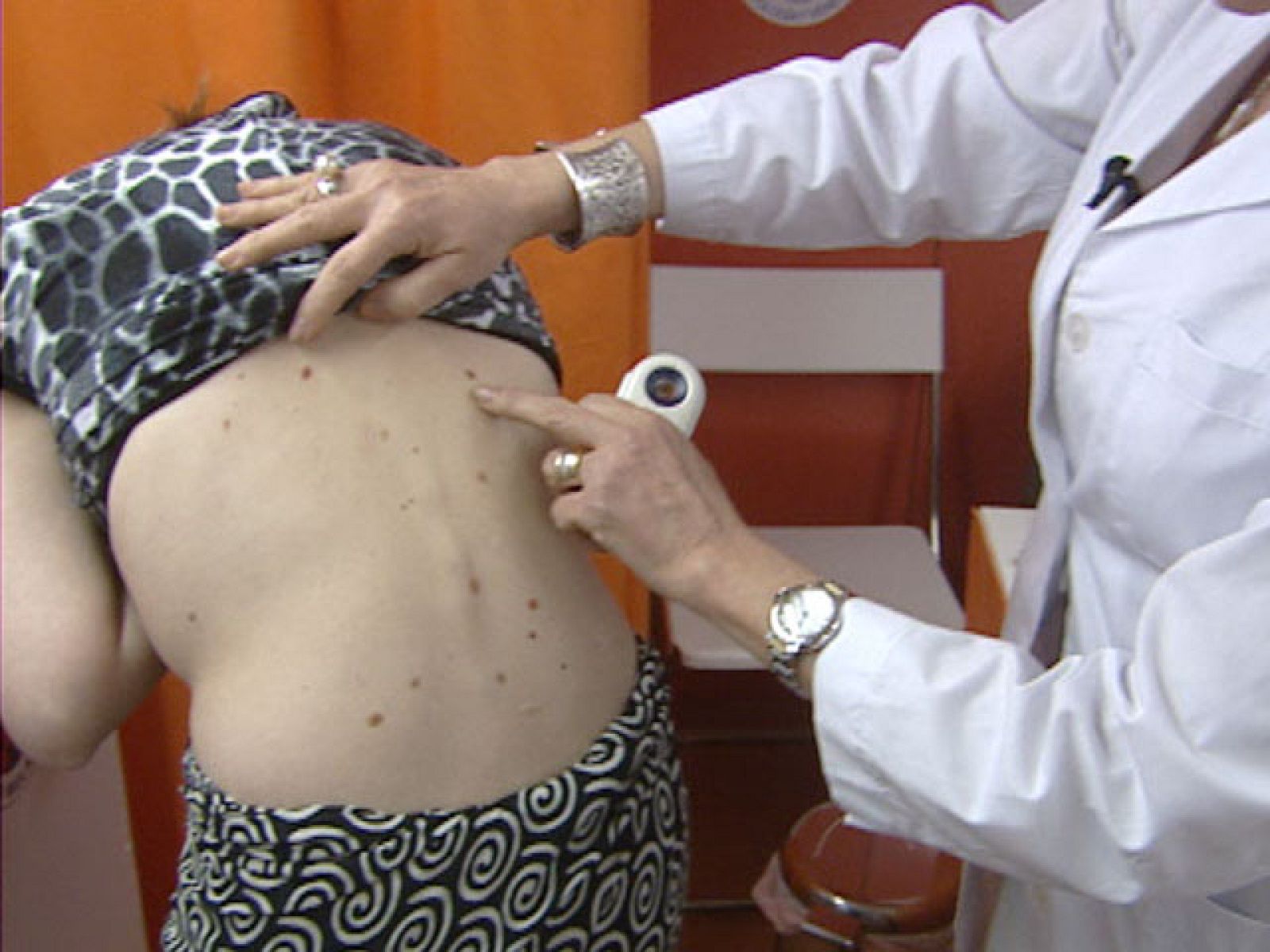 El melanoma es el tipo de cáncer que más aumenta cada año, hasta un 10% - Ciencia y tecnología en Rtve.es | Ver