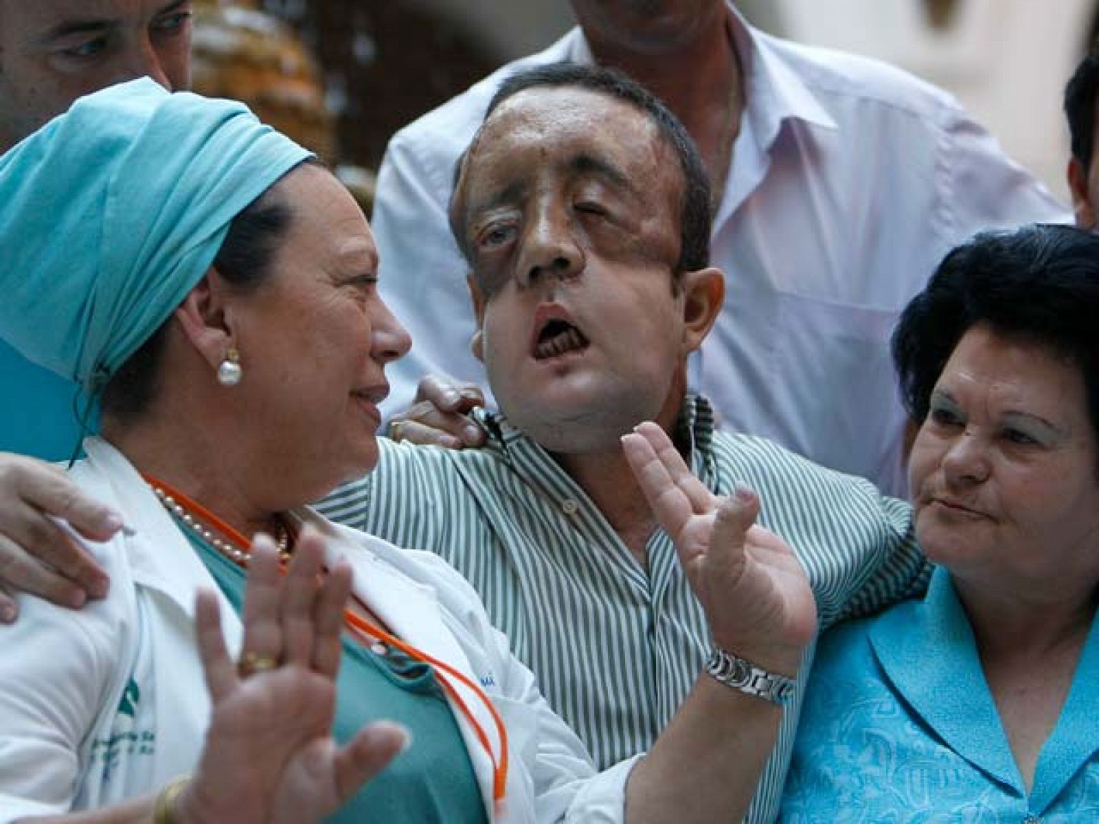 Exitoso trasplante de cara en el hospital Virgen del Rocío de Sevilla