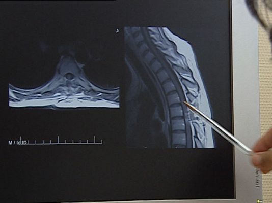Ciencia y tecnología en Rtve.es - Tratamientos con células madre
