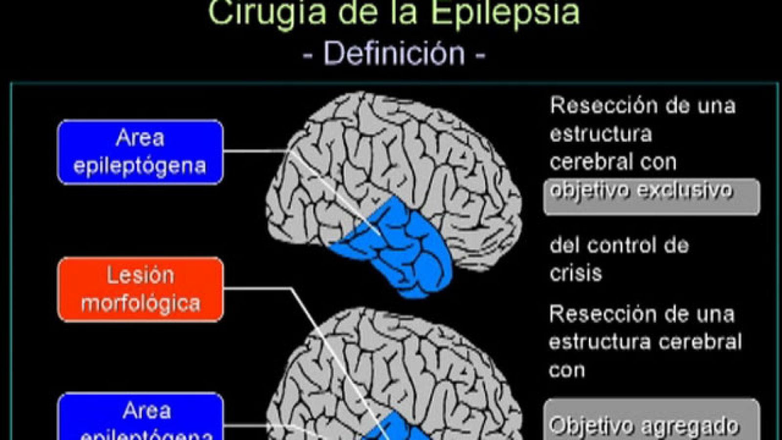 En España hay unas 400.000 personas con epilepsia