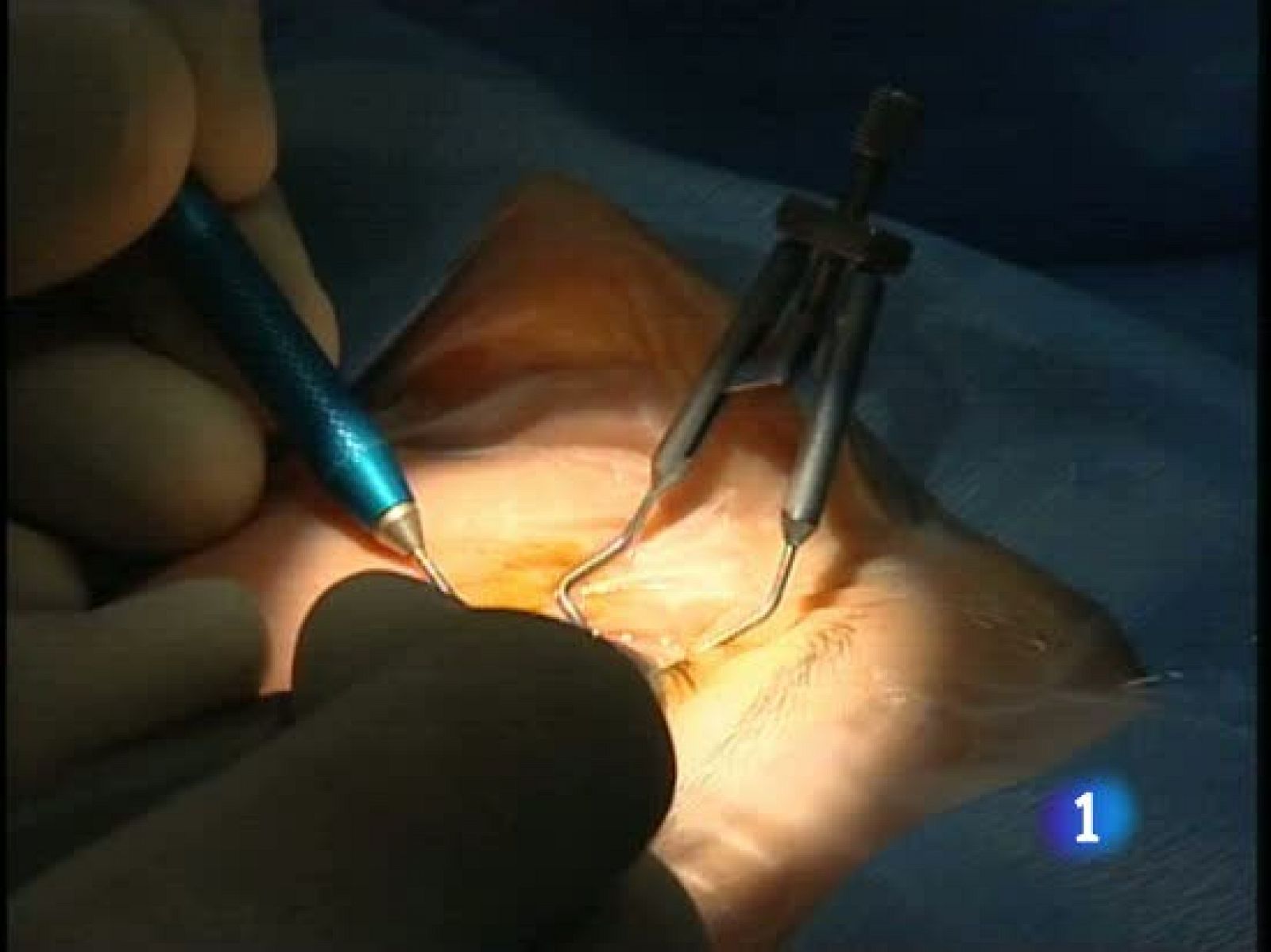 Investigadores suecos logran que 10 pacientes recuperen parte de la visión implantándoles córneas artificiales