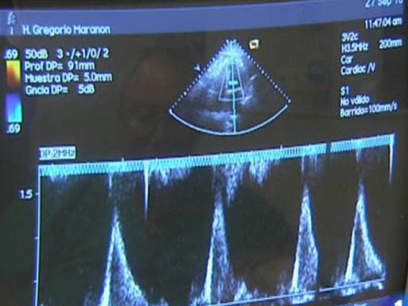 Descubren 9 genes que determinan el riesgo de sufrir infarto