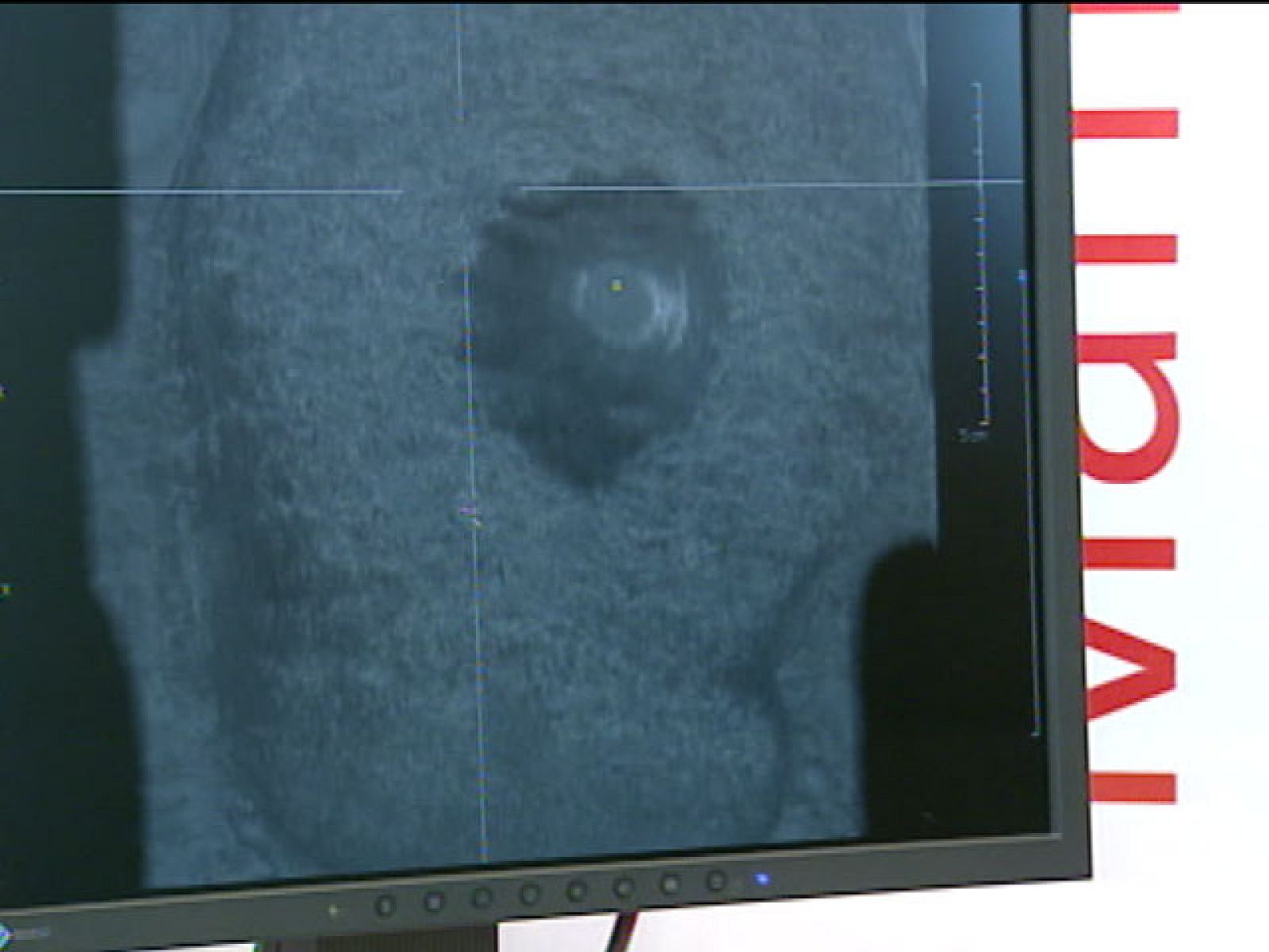 Después de pasar por una mastectomía como consecuencia de un cáncer de mama, algunas mujeres sufren linfedema. Al haber perdido determinados ganglios, el líquido linfático se acumula y provoca una inflamación del brazo. De las soluciones a este problema, que afecta a 4.000 mujeres, se está hablando en un Congreso médico en Valencia.