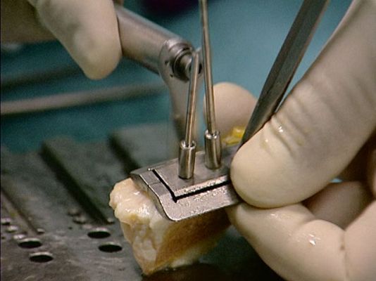 Ciencia y tecnología en Rtve.es - Trasplantes de huesos