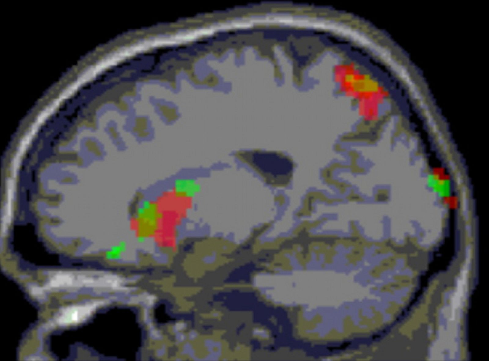 "Ataraxia", incapacidad para sentir frustración