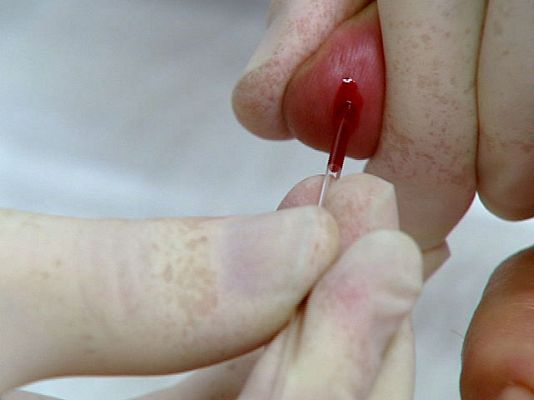 Telediario 1 - Qué riesgo hay de cáncer de pulmón